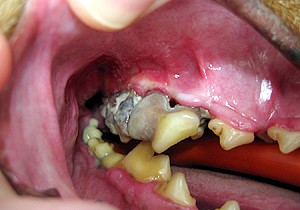 Stage 4 Periodontal Disease