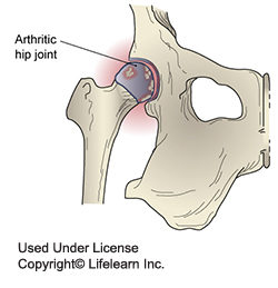 Arthritic hip joint